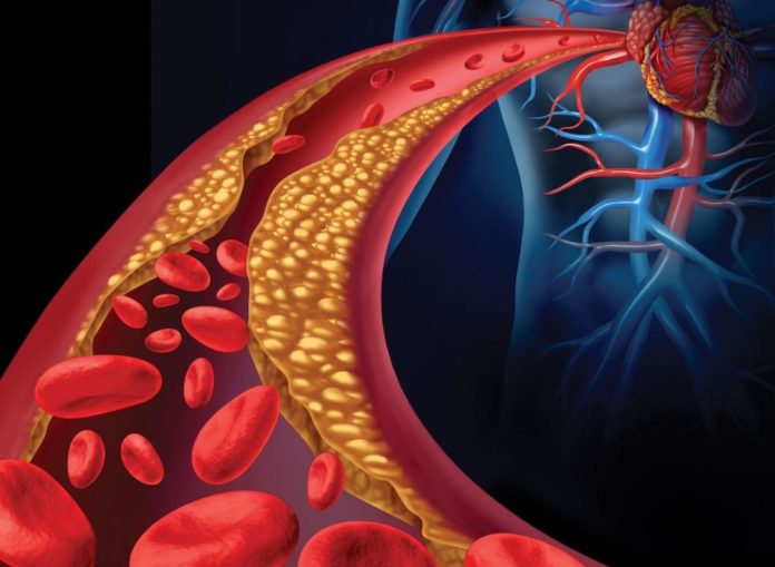 atherosclerosis Soffri di ipertensione? cibi da assumere e da evitare