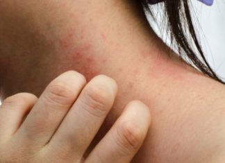 Dermatite atopica? Ecco i cibi irritanti da evitare