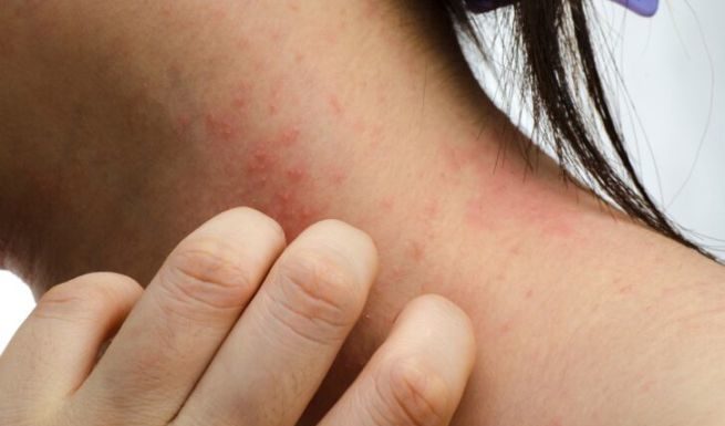 Dermatite atopica? Ecco i cibi irritanti da evitare