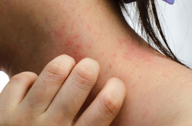 Dermatite atopica? Ecco i cibi irritanti da evitare