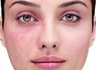 Dermatite atopica? Ecco i cibi irritanti da evitare