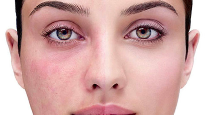 Dermatite atopica? Ecco i cibi irritanti da evitare